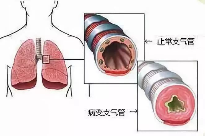 支气 腾讯网