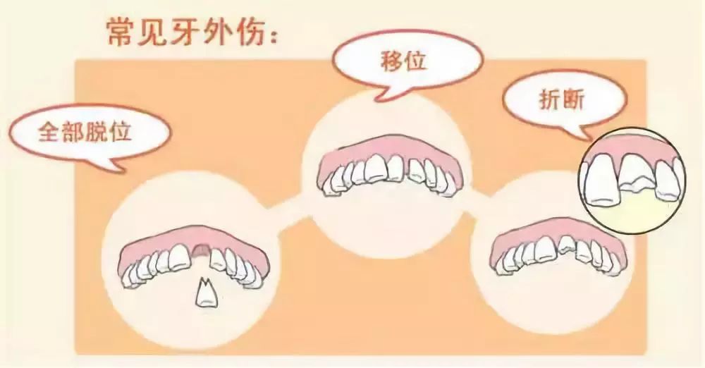 一般来说,6岁以下儿童的牙外伤多为乳牙外伤,7至12岁儿童的牙外伤抖 