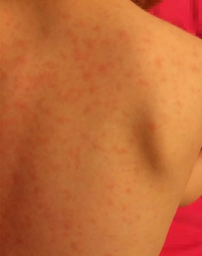 幼儿急疹的皮疹呈玫瑰色,红中透着紫,这就是它别称"玫瑰疹"的由来.