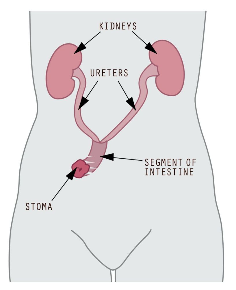 肠管一端连接输尿管,另一端延伸至皮肤形成造口.造口位置在腰带附近.