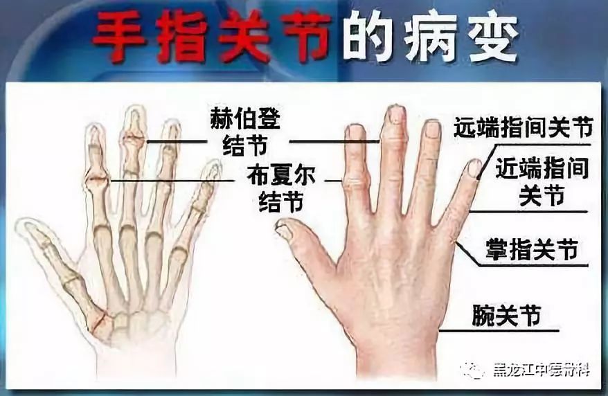 手指关节痛是什么原因?坚持这2个小动作可缓解!