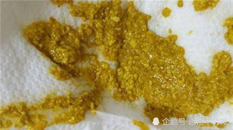 宝宝大便有奶瓣分为哪些类型?应该如何护理?