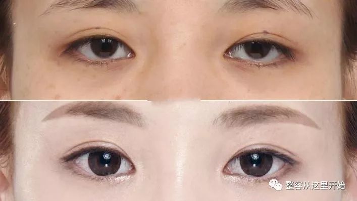 什么样的眼型不适合开眼角