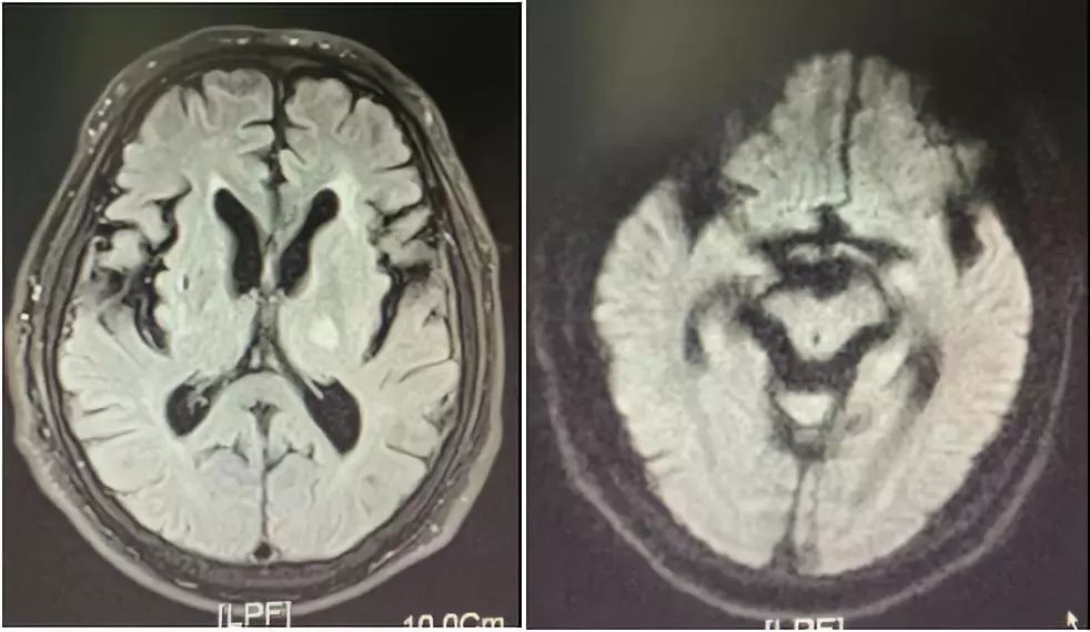 脑干,基底节,侧脑室旁,半卵圆中心可见多发陈旧性梗死病变.