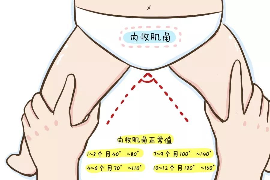 说到剪刀腿,之前有家长咨询,宝宝在体检的时候,迈步的时候双腿交叉