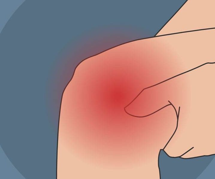 膝盖部位会因积血,以及积液而发作肿胀,中后期会肿得像个水萝卜一样.