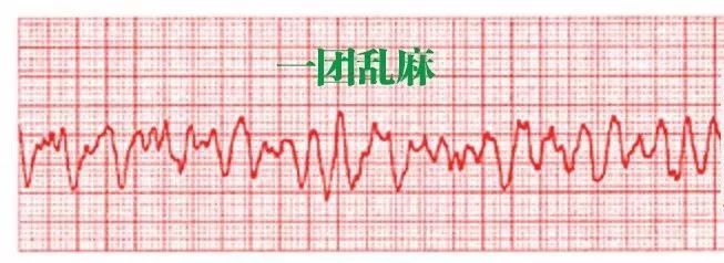 且心率较快(150-220),那就选室速 10 心室颤动 口诀 一团乱麻 特点 p