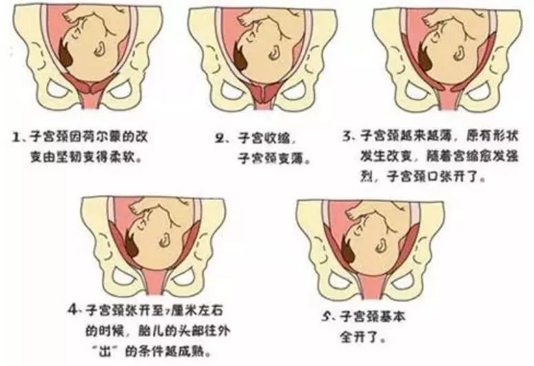 一产程得到休息,当宫口开全时,因积攒了体力而有足够力量完成自然分娩