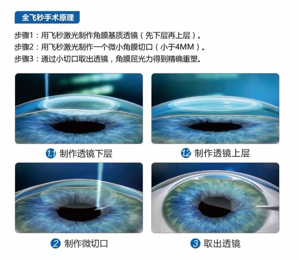 主流近视手术大解密!一文读懂全飞秒和icl的区别