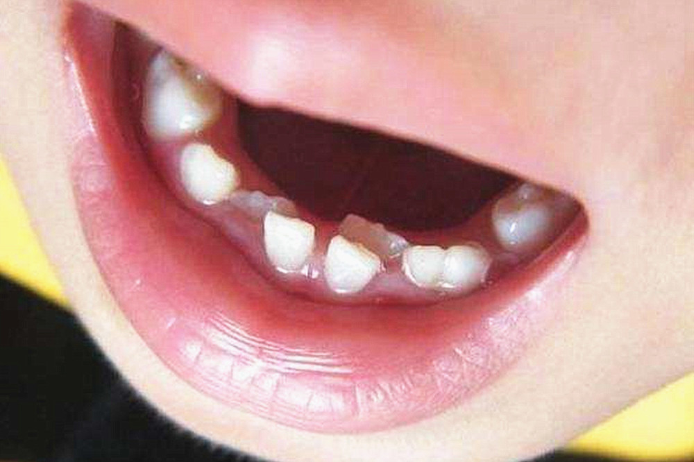 造成牙齿不齐 牙齿对人的影响是非常大的,尤其在孩子换牙期间,如果
