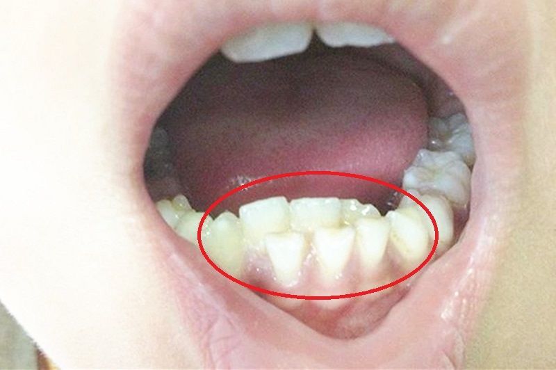 父母不注意这4点,小心孩子牙齿长歪,第一个很多家长都