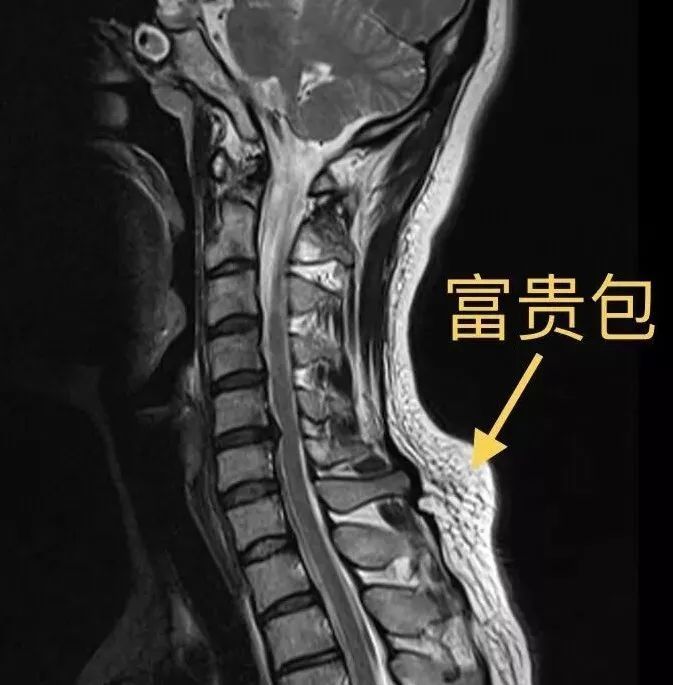 颈椎病,富贵包,颈椎疼痛