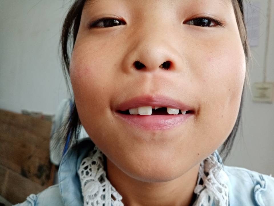 10岁女孩在学校磕断门牙,家长须做一件重要的事情,却常被忽视