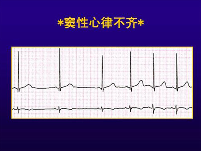 心脏病,心律不齐,窦性心律不齐
