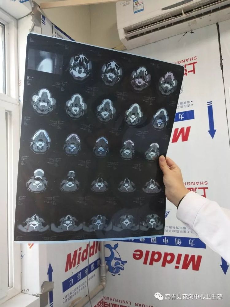花沟中心卫生院ct机第一张影像片诞生 看点快报