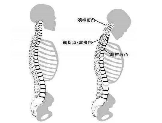 对于轻微的胸椎后凸并没有严重脊柱变形的人群,其实运动是最好的改善