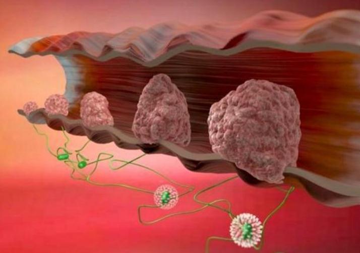 肠癌多是"拖"出来的,身体若有这3种表现,可能肠道"病"