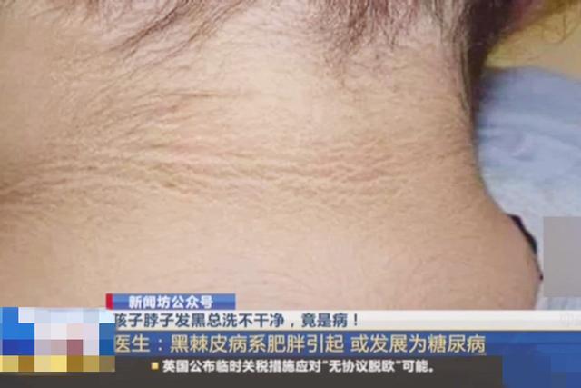 9岁女童脖子后面发黑,越搓越严重,儿科大夫的一句话让爸爸笑了