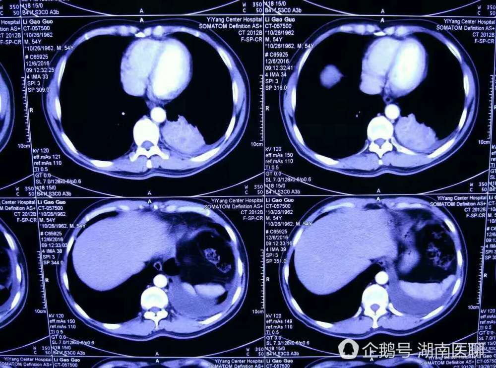 男子反复咳嗽咳痰 原是支气管里 辣椒尖 作祟