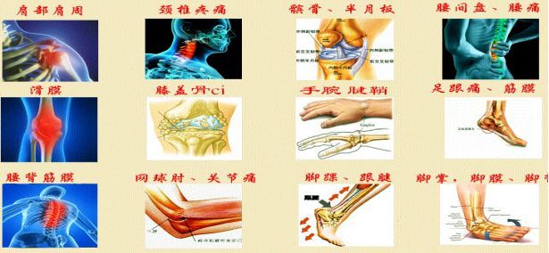 软组织损伤主要包括擦伤,挫伤,撕裂撕脱伤,急性腰扭伤,慢性腰肌劳损