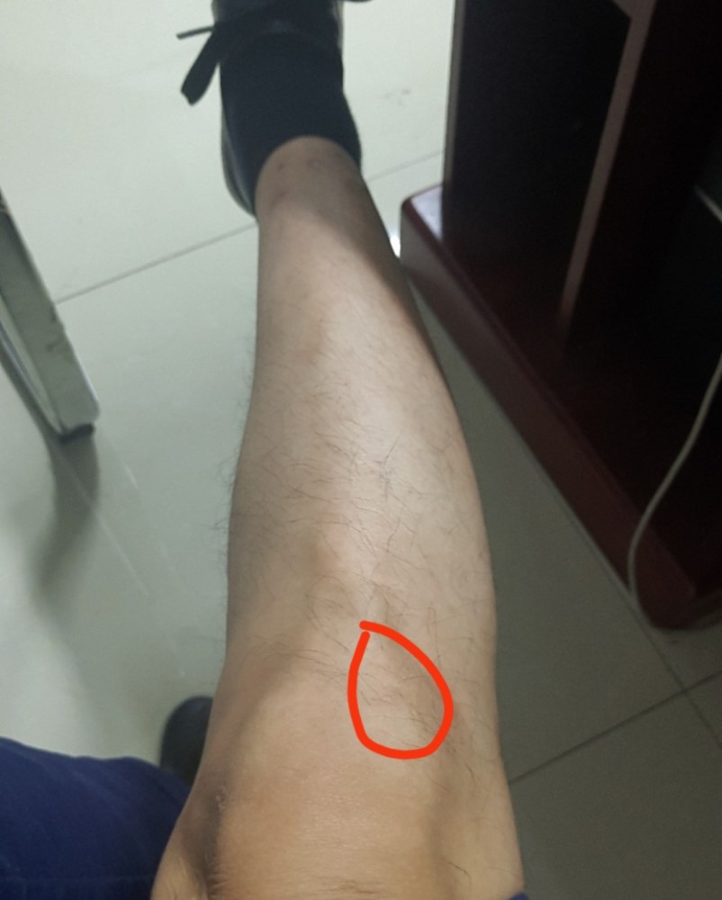 髂胫束,膝关节,膝盖