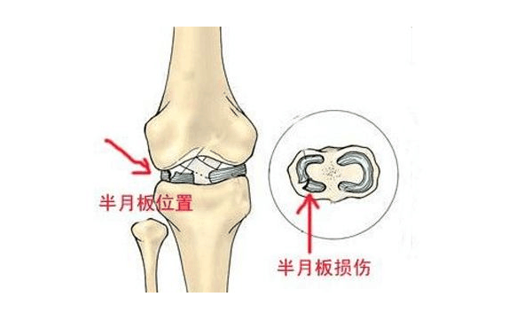 罗圈腿不仅难看,时间一久引起膝关节半月板损伤!