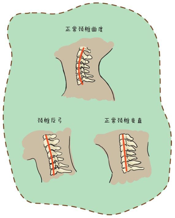 颈部,颈椎,椎间盘