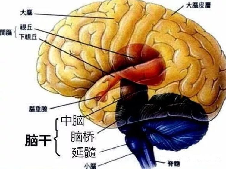 脑干出血,闵有会,脑出血