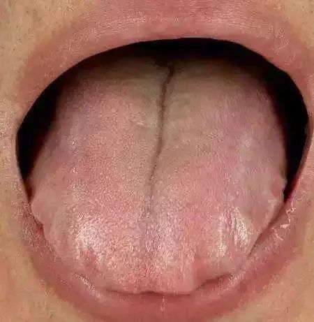 痰湿体质的孩子舌头胖大; 舌头的边缘是锯齿状的;舌苔白厚,滑而湿润.