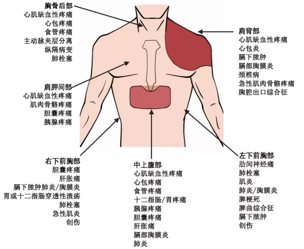 常见胸痛部位和病因