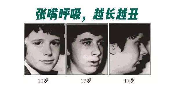 家有儿女必看:口呼吸会让孩子变龅牙,颜值尽毁,家长要提高警惕!