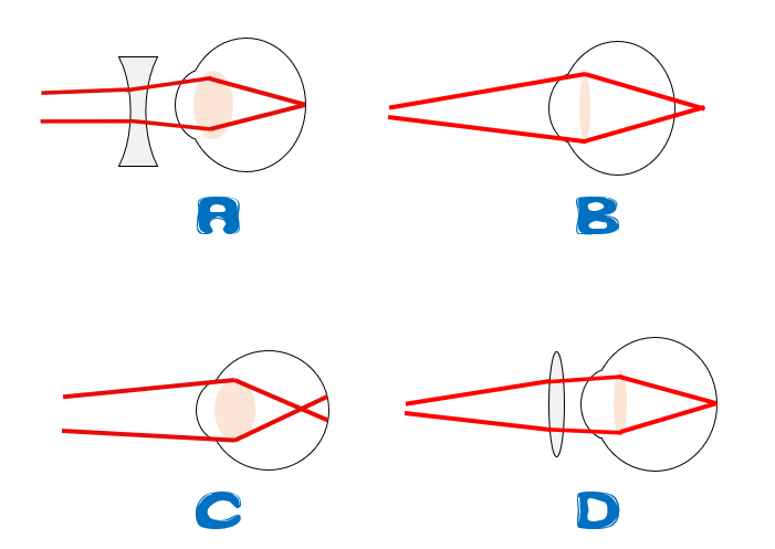 (填空题)如图所示的四幅图中,正确表示远视眼成像情况的是图(  ),其
