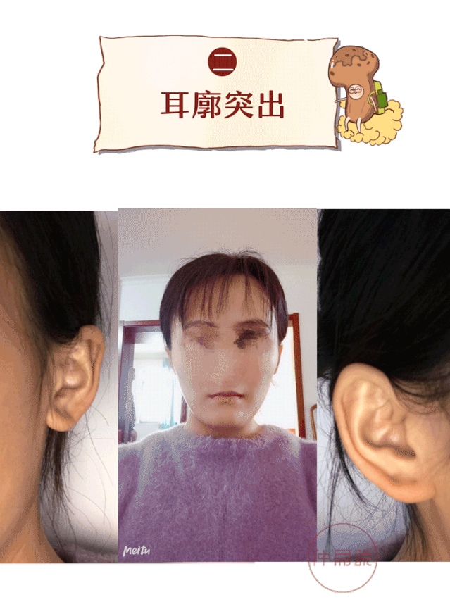 人际:耳朵无垂珠,说明六亲缘分浅,自身又比较敏感,人际交往方面会