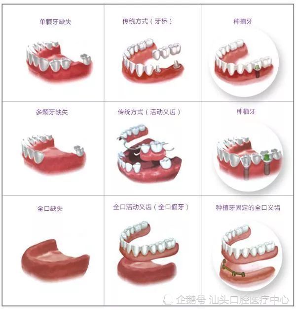 种植牙,又叫种植义齿,是医学纯钛材料制成的一种仿生牙,其材质如同