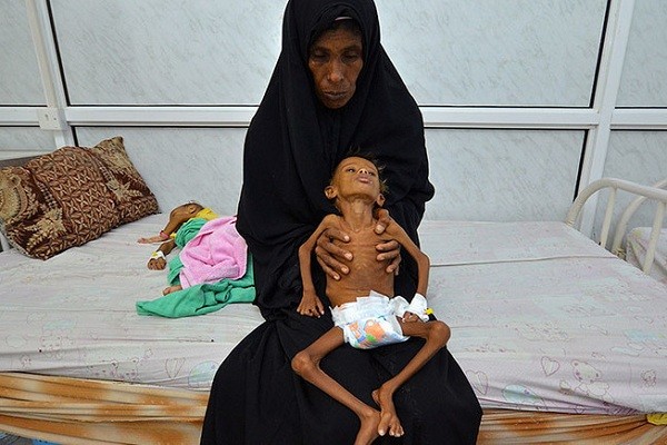 也门儿童瘦成皮包骨形似骷髅,肋骨根根分明令人揪心