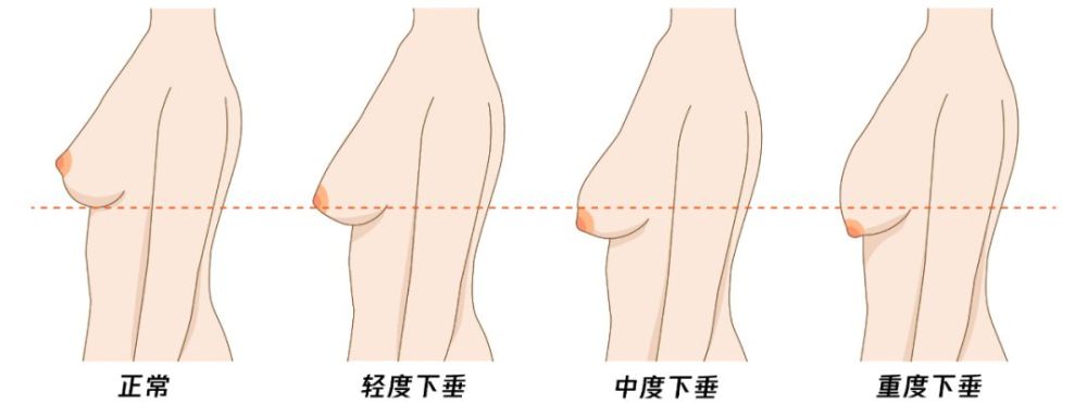 医生提醒:为什么有些女性乳房下垂,有人却"坚挺"?今天