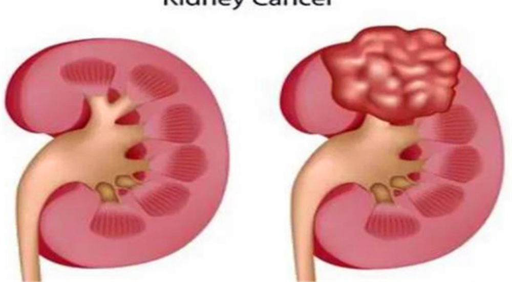 肾囊肿是怎么形成的?得注意什么?