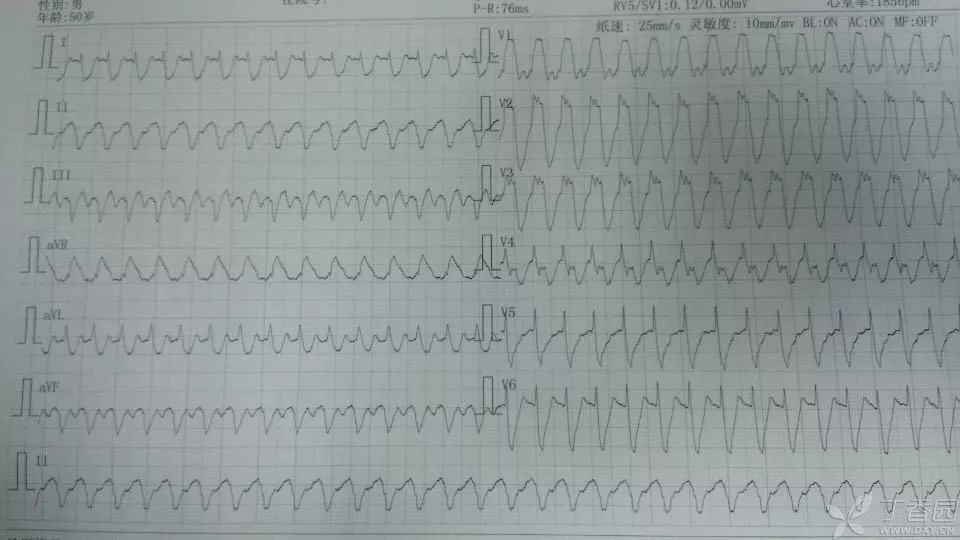 心电图,室速,心律失常