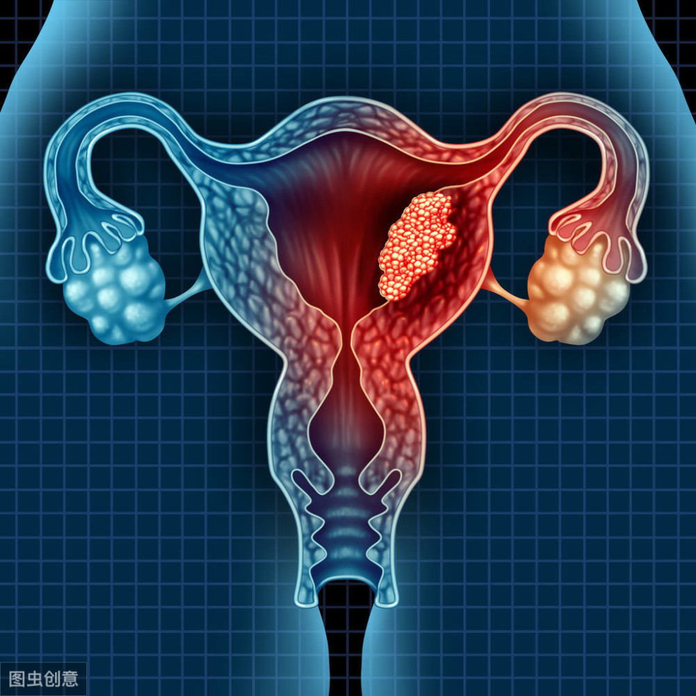 女子突然来月经,被确诊为宫颈癌,医生:超过45岁的女性