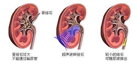 肾结石排石请认准这三个方法,每一种都能让你安全有效