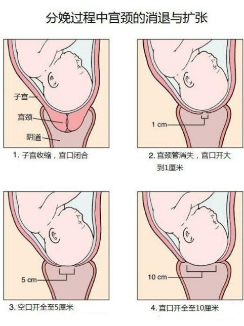 第三张图:宫缩开始后宫颈管消失到宫口到开到十指时的模样,以胎儿头位