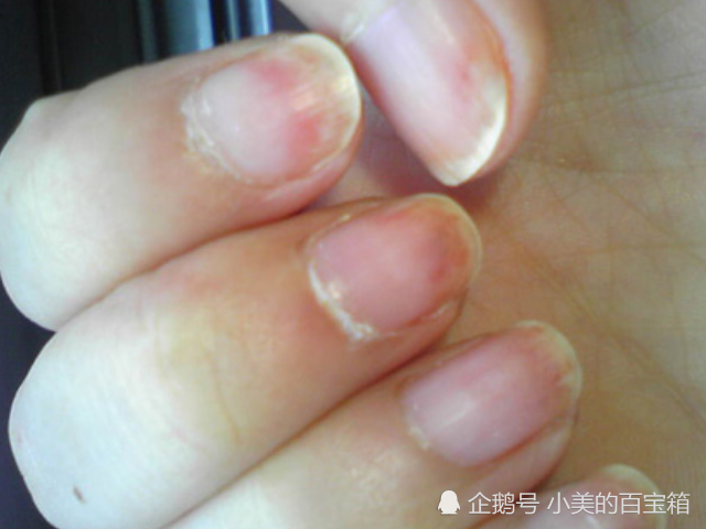 指甲出现"竖纹"别大意,或是这几种"疾病",务必打起十二分精神