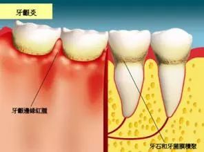 牙龈,牙齿,牙龈炎,牙周炎,牙菌斑,肺部,吸烟,心脏病,长寿