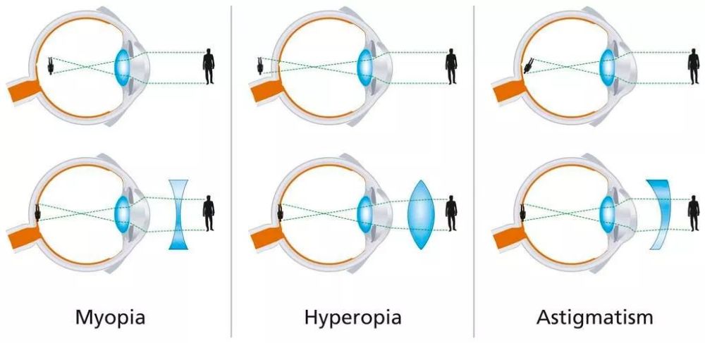 近视,远视,散光成像与矫正图源 | 锐景图库 正常的角膜表面应像个