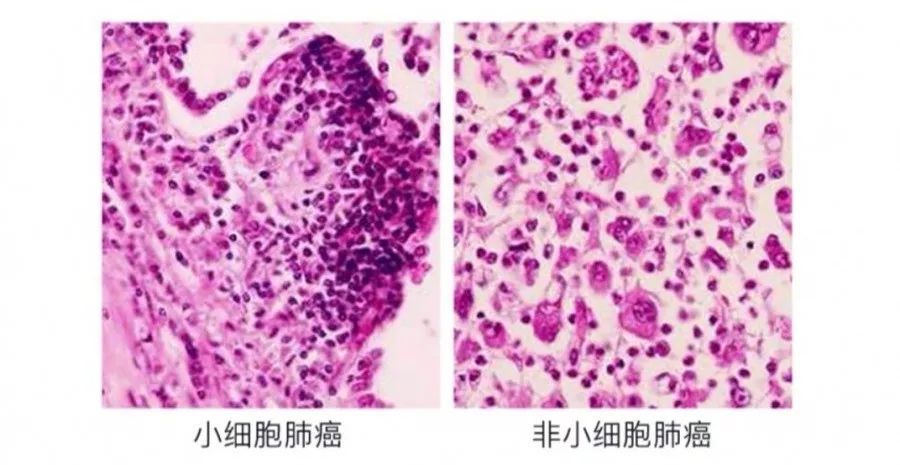 帕博利珠单抗联合化疗一线治疗转移性鳞状非小细胞肺癌在华获批