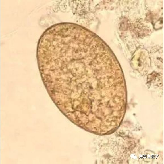 华支睾吸虫卵 肝吸虫卵像芝麻, 最小虫卵就是它. 卵盖肩峰小尾巴