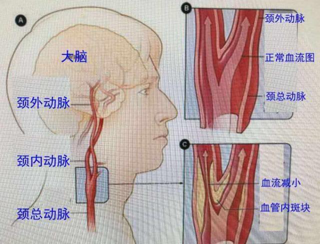 为什么颈动脉容易堵塞,该如何预防?医生讲的通俗易懂