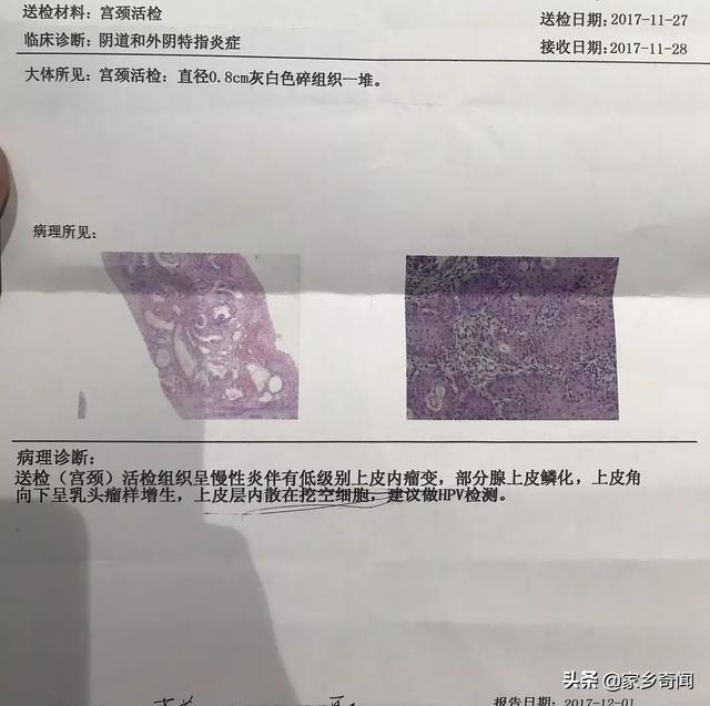 hpv,医生,补充维生素,增生,敷料,蛋白