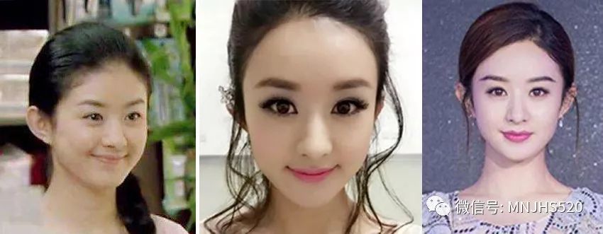 脂肪,面部,脸型,婴儿肥,吸脂,颧骨