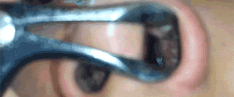 经常流鼻血不是上火,可能是寄生水蛭钻进了你的鼻腔